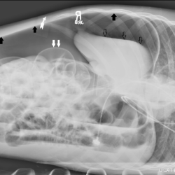 Decubitus lateral radiopaedia